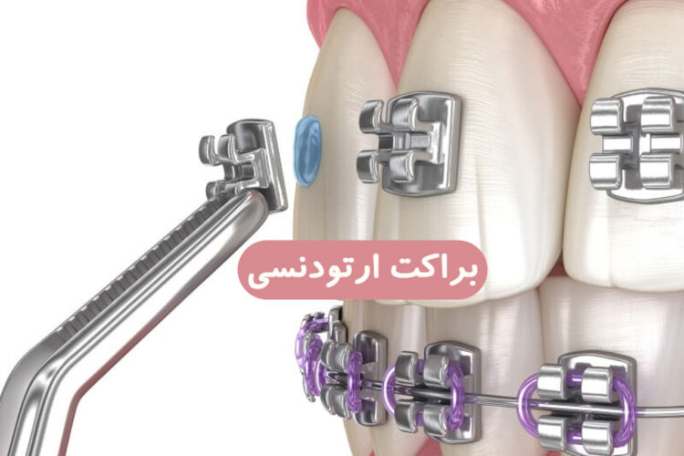 براکت ارتودنسی