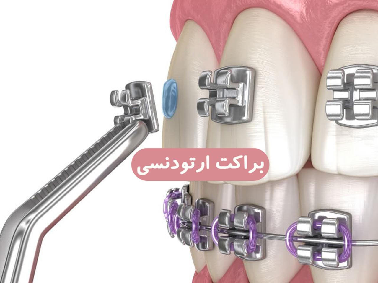 براکت ارتودنسی