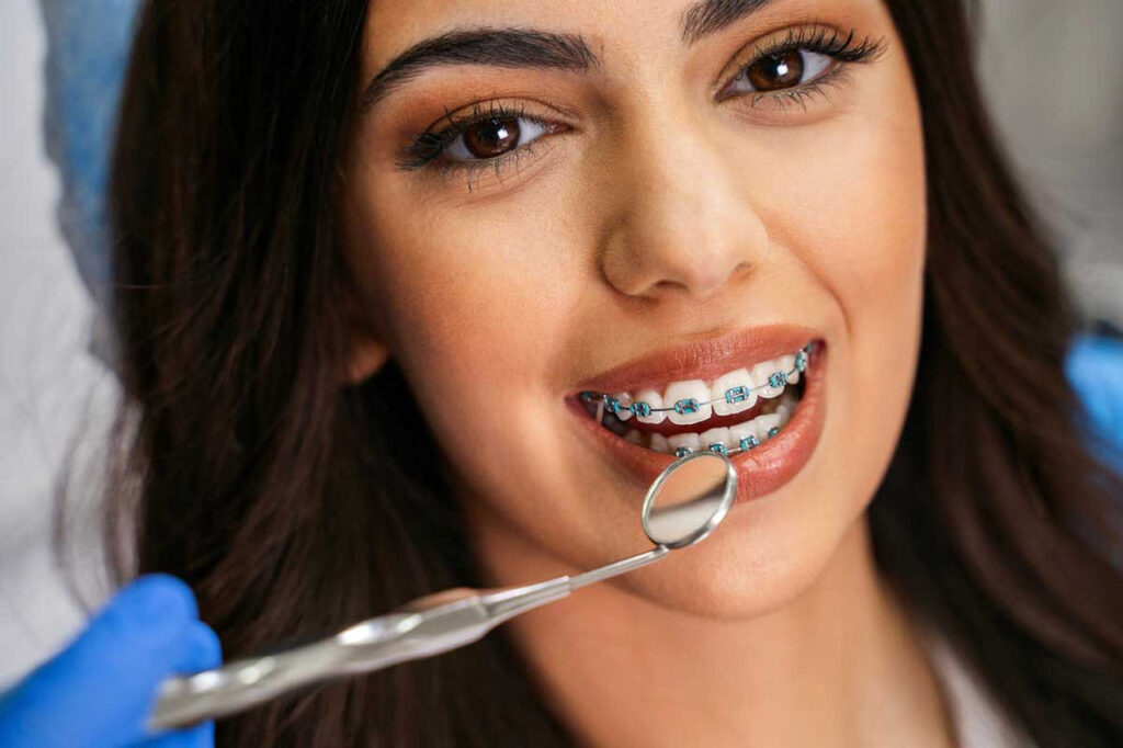 براکت‌های ثابت ارتودنسی