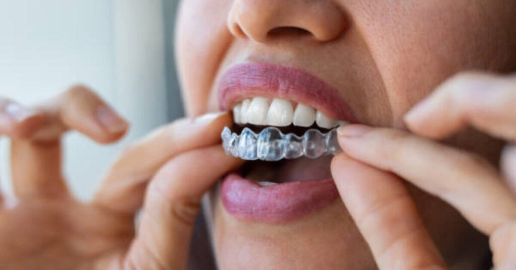 ارتودنسی نامرئی اینویزیلاین