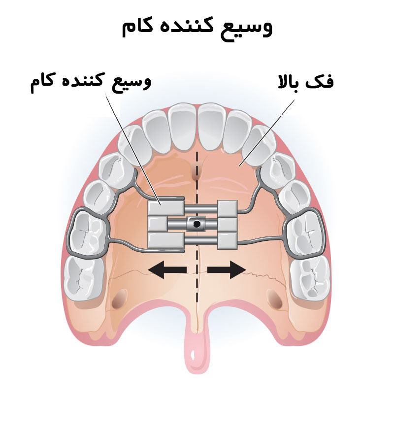 وسیع کننده کام(پالاتال اکسپندر)
