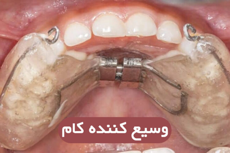 وسیع کننده کام(پالاتال اکسپندر)