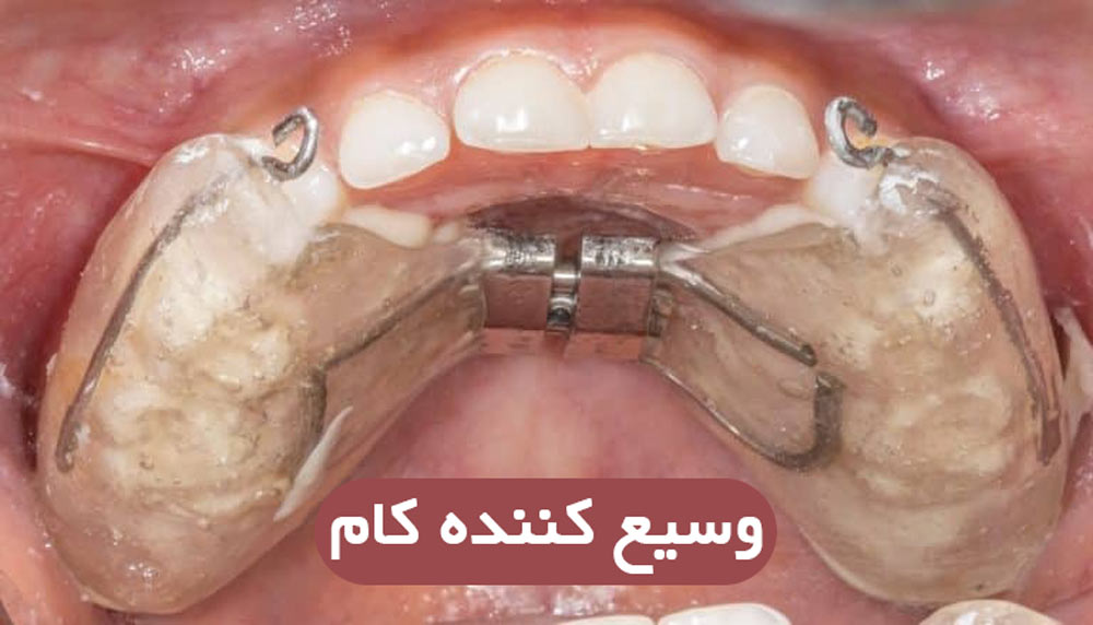 وسیع کننده کام(پالاتال اکسپندر)