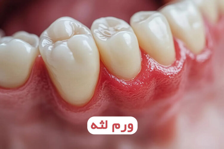 ورم لثه