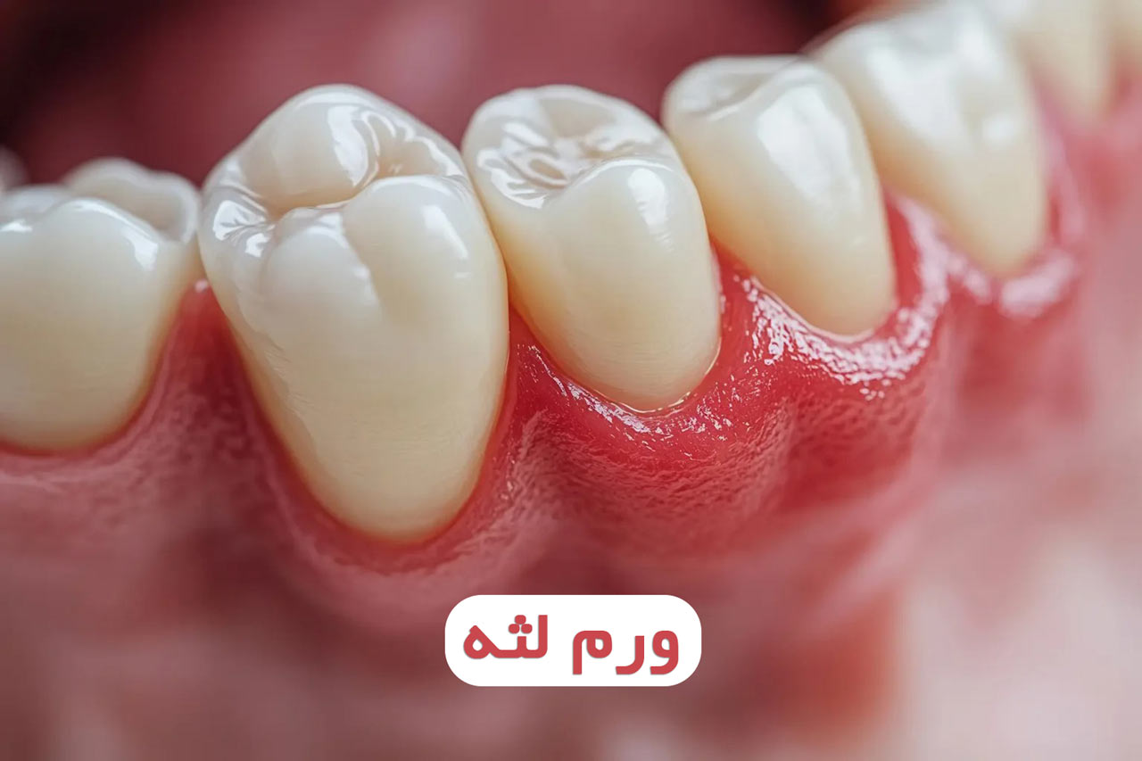 ورم لثه