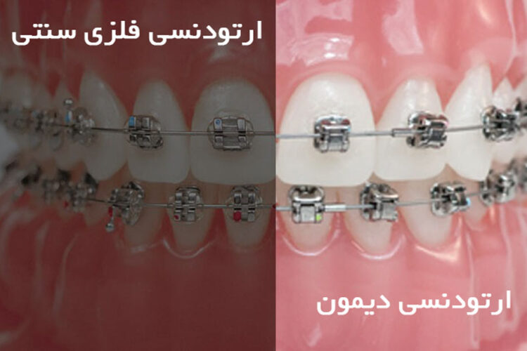 ارتودنسی دیمون بهتر است یا ارتودنسی فلزی سنتی؟