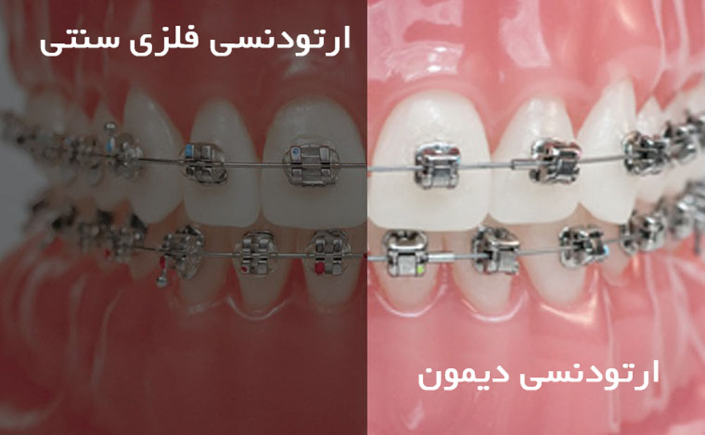 ارتودنسی دیمون بهتر است یا ارتودنسی فلزی سنتی؟