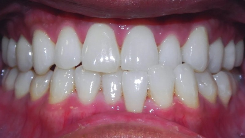 انواع کراس بایت (کراس بایت قدامی)