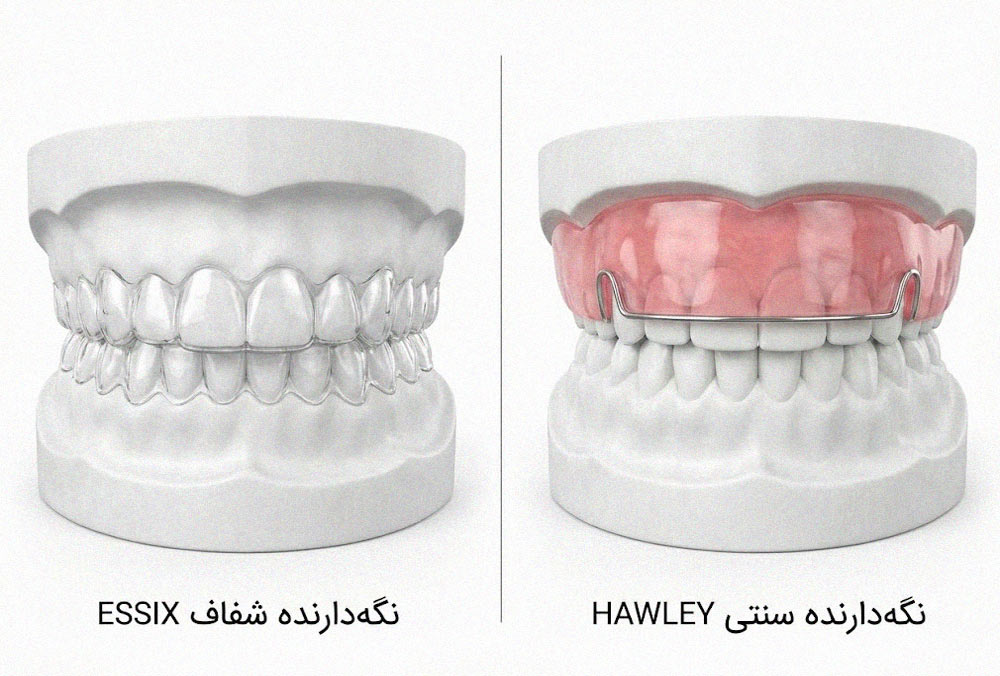 مقایسه تفاوت ظاهری و ساختاری ریتینر شفاف اسیکس و ریتینر سیمی هاولی