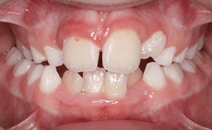 انواع کراس بایت (کراس بایت خلفی)