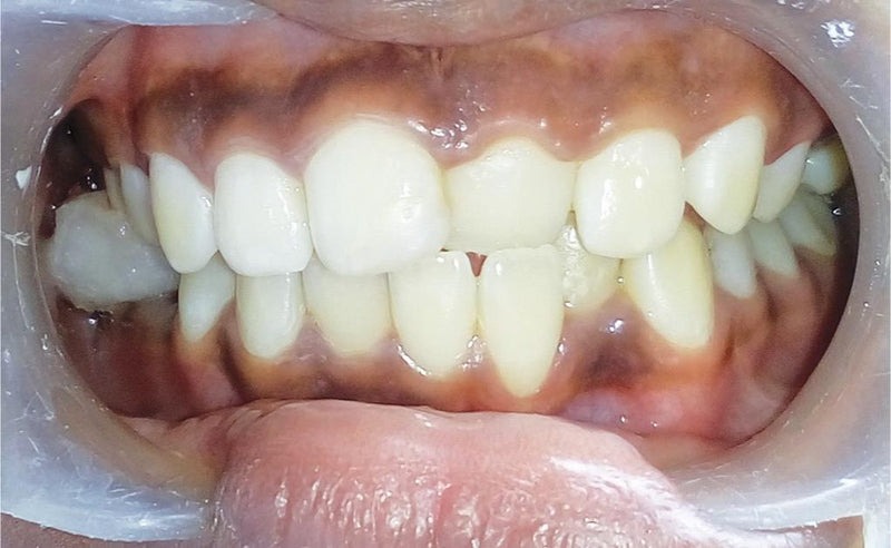 انواع کراس بایت (کراس بایت تک دندانی)