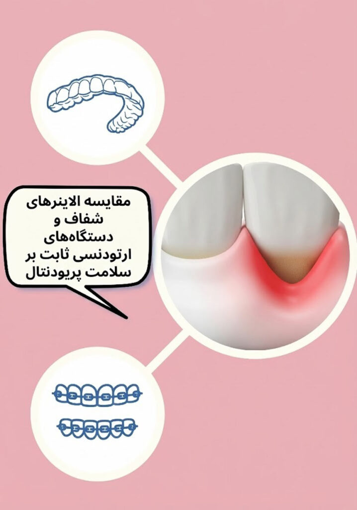 درمان بیماری‌های لثه الاینرهای شفاف بهتر از ارتودنسی‌های ثابت
