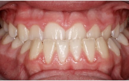 انواع کراس بایت (کراس بایت دو طرفه)