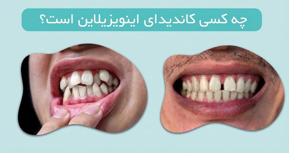 کاندید مناسب برای درمان اینویزیلاین