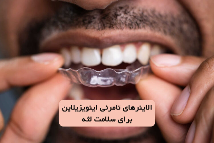 الاینرهای نامرئی اینویزیلاین برای سلامت لثه و مدیریت بیماری پریودنتال