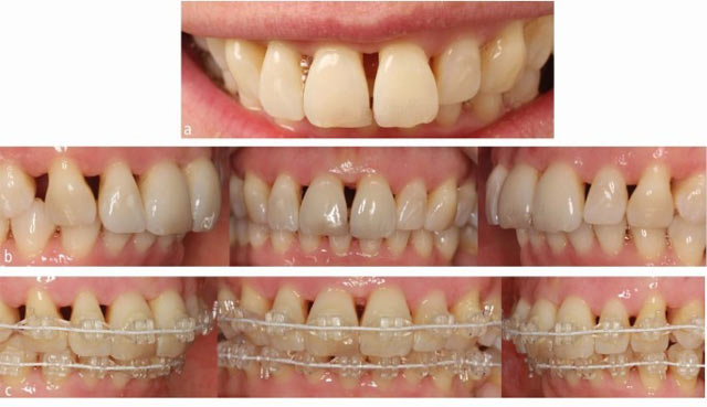 درمان ارتودنسی و ابتلا به بیماری‌های لثه