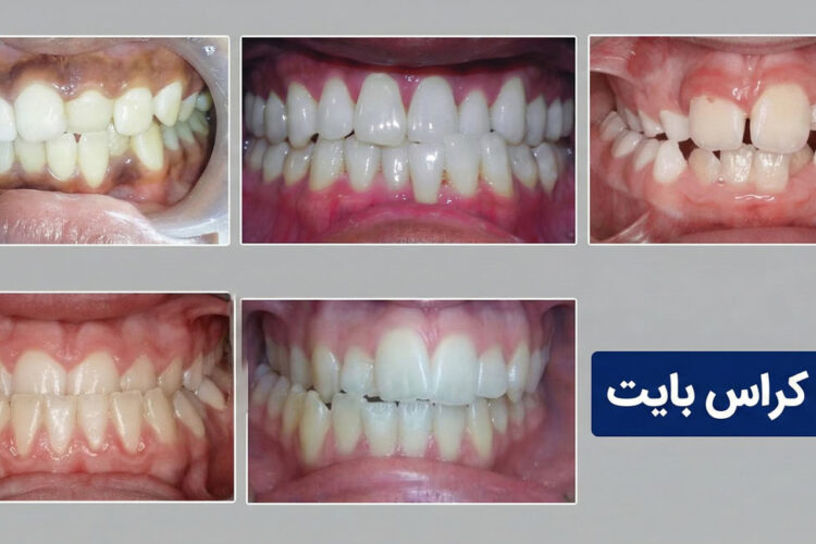 انواع کراس بایت