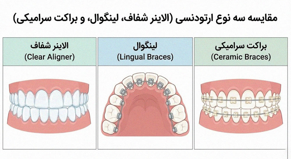 اینفوگرافیک مقایسه انواع ارتودنسی نامرئی، لینگوال و براکت سرامیکی