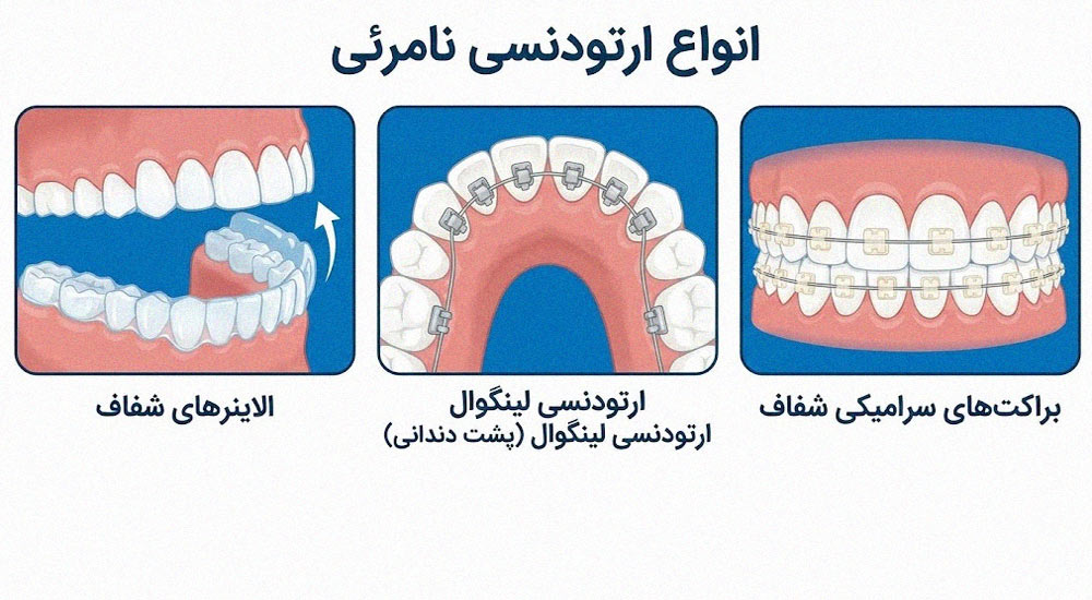 اینفوگرافیک انواع ارتودنسی نامرئی شامل الاینر شفاف، لینگوال و سرامیکی