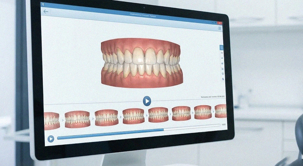 اسکن سه بعدی فک و نمایش مراحل حرکت دندان در ارتودنسی دیجیتال