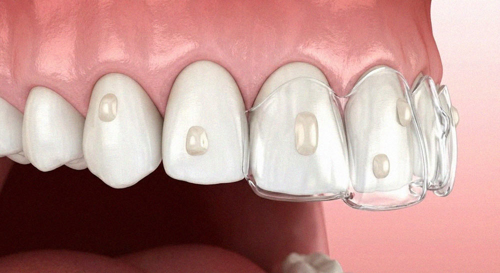 نمای نزدیک اتچمنت یا برجستگیهای کامپوزیتی روی دندان در درمان با الاینر