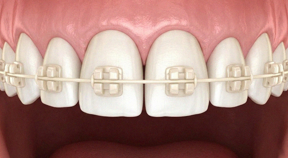کلوزآپ براکتهای سرامیکی شفاف و همرنگ دندان