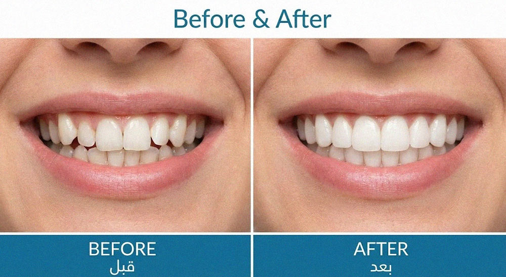 عکس قبل و بعد درمان دندانهای نامرتب با ارتودنسی نامرئی