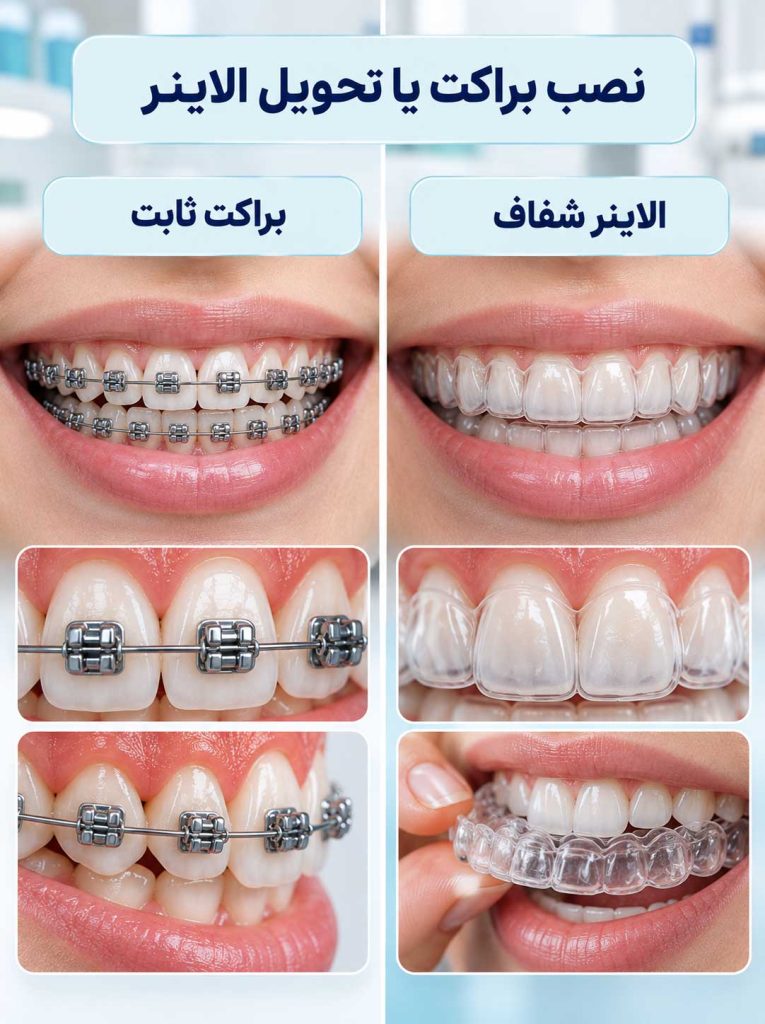 نصب براکت ثابت یا تحویل الاینر