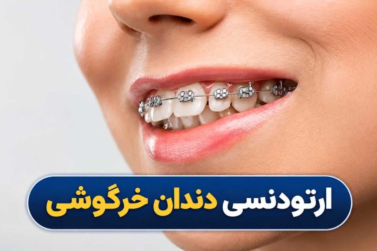 ارتودنسی دندان خرگوشی