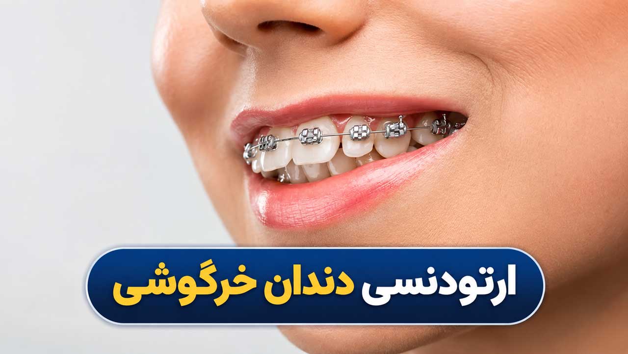 ارتودنسی دندان خرگوشی