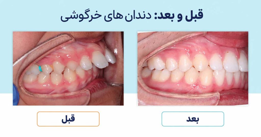 قبل و بعد درمان دندان خرگوشی با ارتودنسی