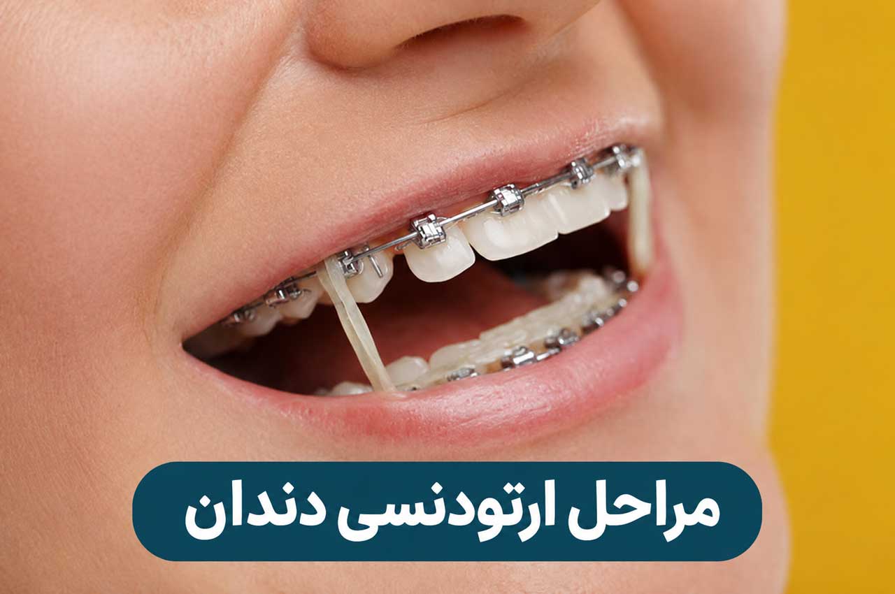مراحل ارتودنسی دندان