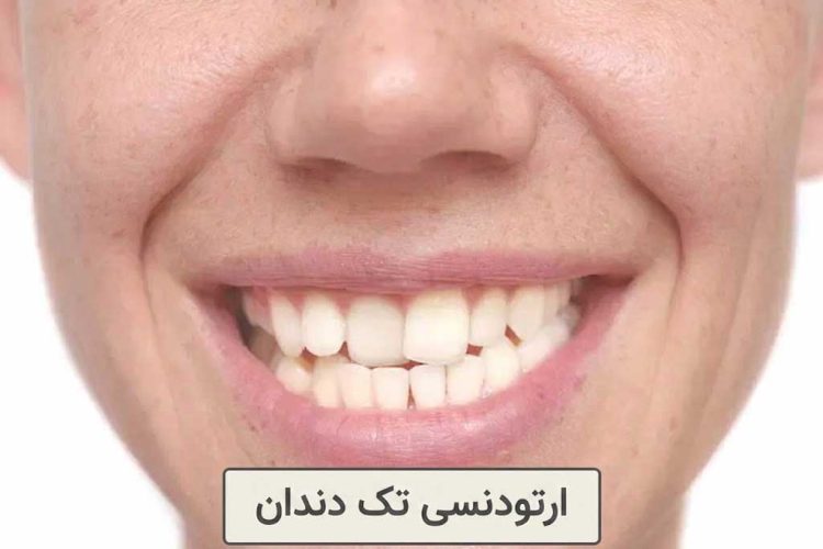 ارتودنسی تک دندان