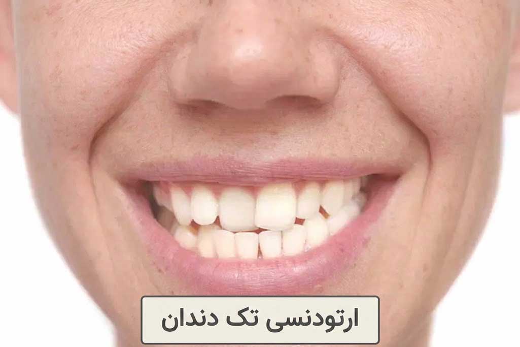 ارتودنسی تک دندان
